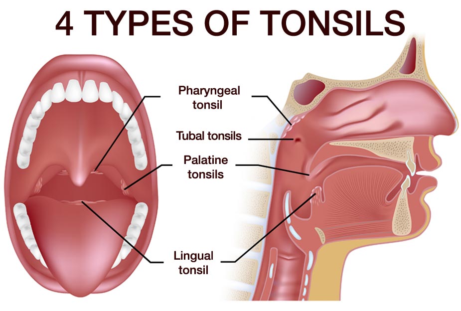 Types of tonsil stones